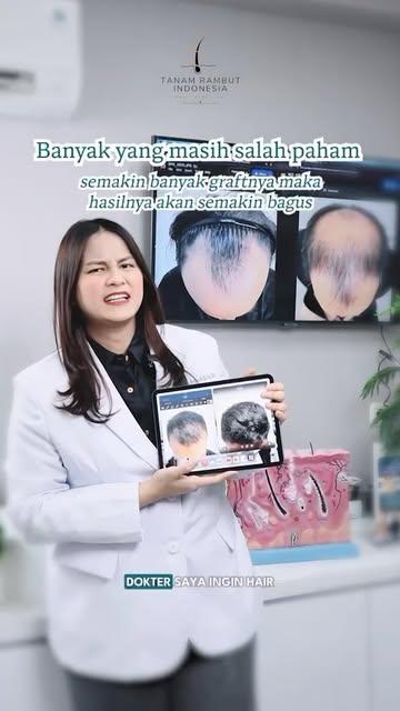 Banyak orang mengira semakin banyak graft yang ditanam, semakin bagus hasilnya.

Padahal, hair trans