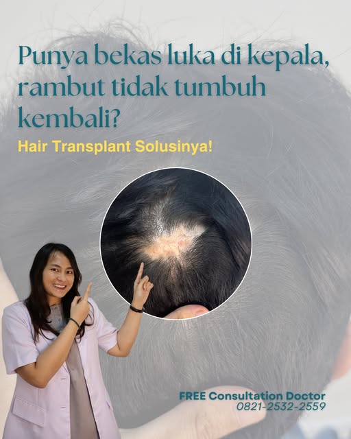 Punya bekas luka di kepala, tapi rambut tidak tumbuh kembali? Jangan langsung menyerah hair transpla