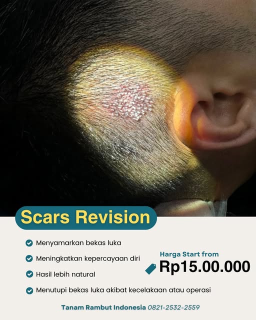 Bekas luka di kulit kepala akibat operasi, kecelakaan, atau prosedur hair transplant sebelumnya bisa