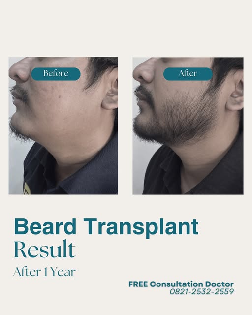 Hasil beard transplant setelah 1 tahun.

Dari area janggut yang tipis hingga pertumbuhan yang lebih 