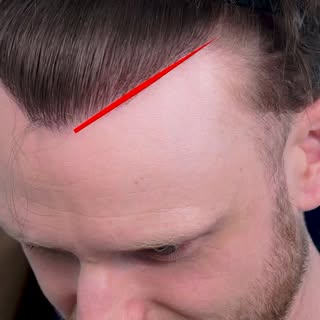 Most people think going to Turkey for a hair transplant is a “safe shortcut.”
But what happens when 
