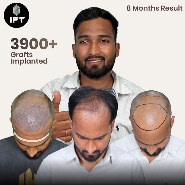 8 months result . 3900 Grafts 
A good hair transplant is not just about adding grafts.
It’s about ma
