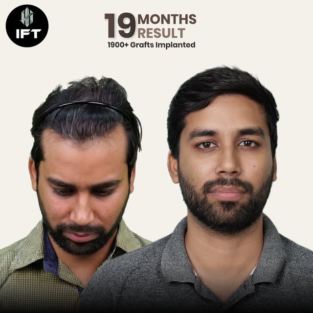 A good hair transplant is not just about adding grafts.
It’s about making them look like your own ha