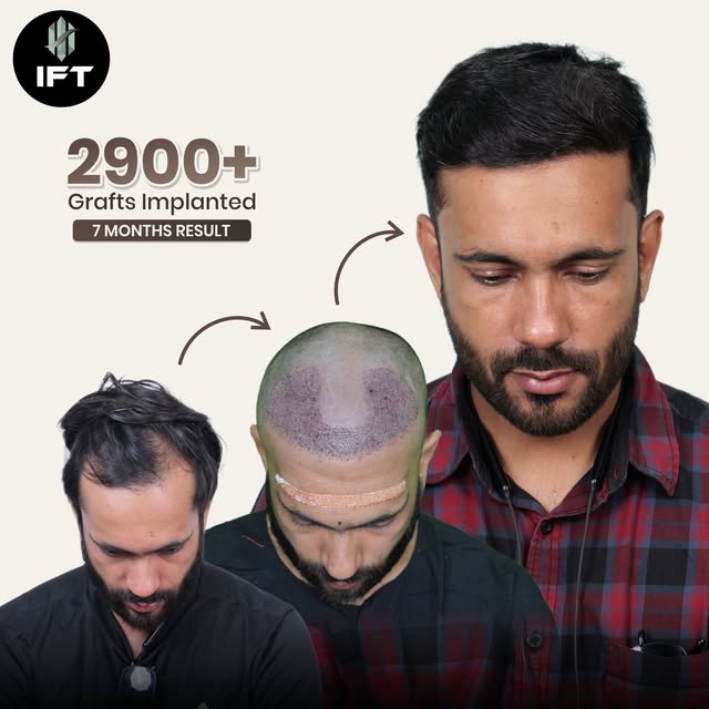 2900+ Grafts Implanted. 7 Months Result. 

A good hair transplant is not just about adding grafts.
I