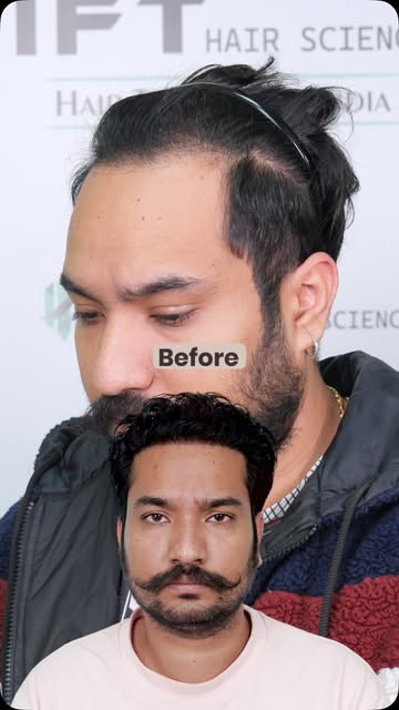 2800+ grafts. From hairline planning to a visible 9-month result — precision in every step.

Clinica
