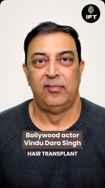 From the screen to a new chapter. 🎬

A Bollywood actor’s hair transplant journey at IFT Hair Scienc