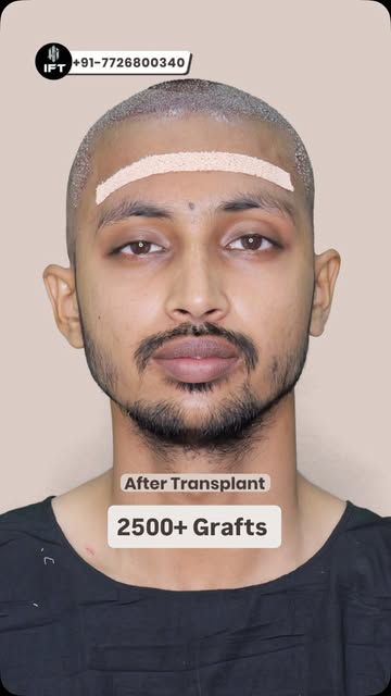 Hairline peeche ja rahi hai ya hairfall sab remedies karne ke baad bhi nhi ruk rha hai ? 

Shayad ab
