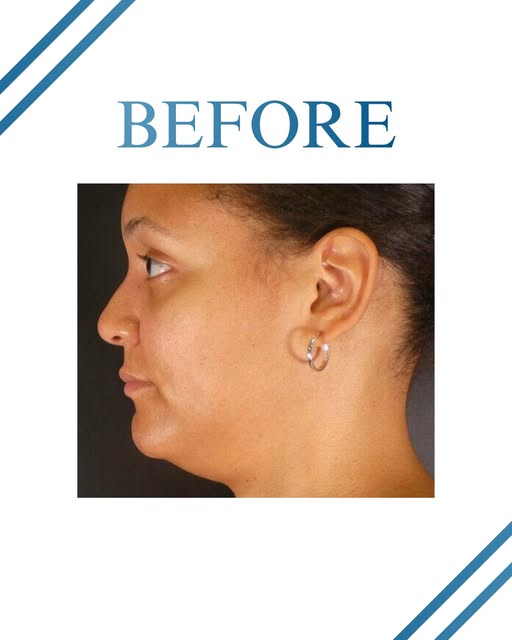 Results like this come from planning, not luck. #aesthetics #cosmetics #beforeandafter #doctor #resu
