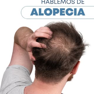 La alopecia afecta a hombres y mujeres de distintas formas, según su causa y gravedad.

Si notás alg