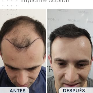 En cada pelo implantamos confianza, seguridad y autoestima ✨. Queremos que vuelvas a sentirte 100% v