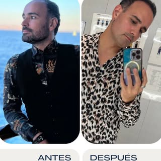 ✨ Gonzalo no deja de sorprenderse con los resultados de su implante capilar.

🎉 ¡Llevate la misma s
