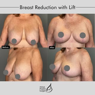 #aMAYSingTransformation | Breast reduction and lift by Board-Certified Plastic Surgeon @drchetmays i