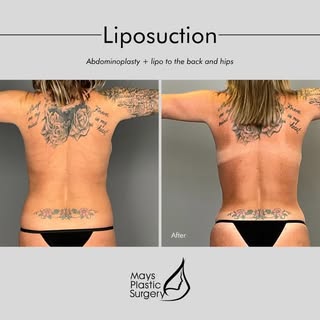 #TransformationTuesday | Whether you’re considering liposuction on its own or in combination with a 
