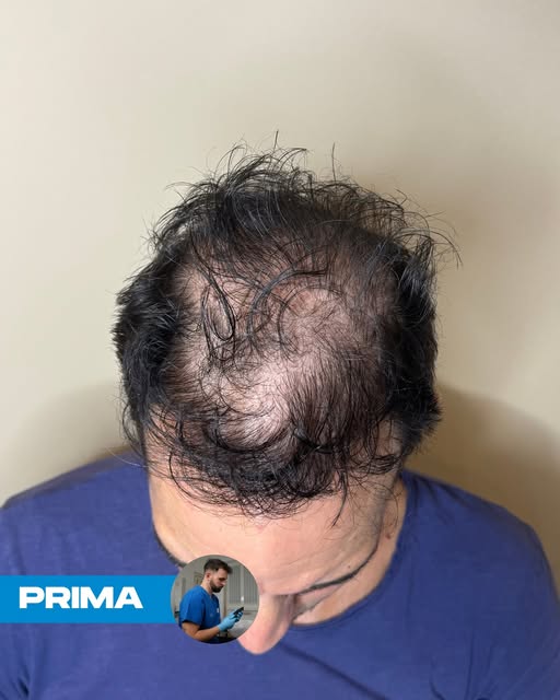 ✨ PRIMA ➡️ DOPO ✨

👤 Cliente con trapianto di capelli effettuato alcuni anni fa.
🎯 Con la tricopig