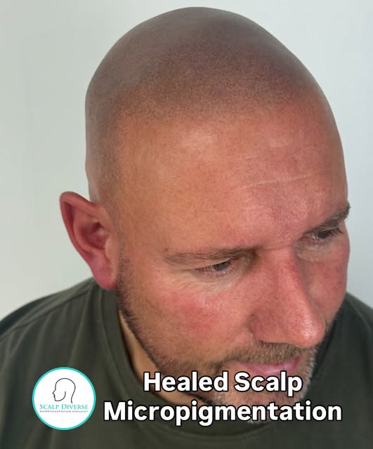 We always aim to show you as much healed scalp Micropigmentation treatments as we can. SMP treatment