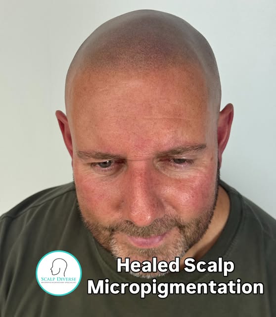 We always aim to show you as much healed scalp Micropigmentation treatments as we can. SMP treatment