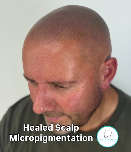 We always aim to show you as much healed scalp Micropigmentation treatments as we can. SMP treatment