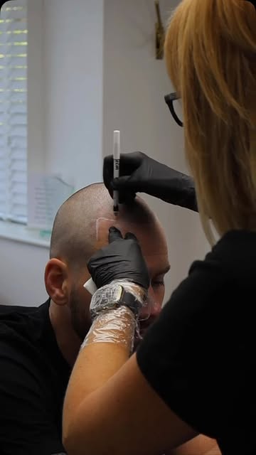 Tired of hiding your hairline under a hat? Scalp Micropigmentation gives you a natural, full look th