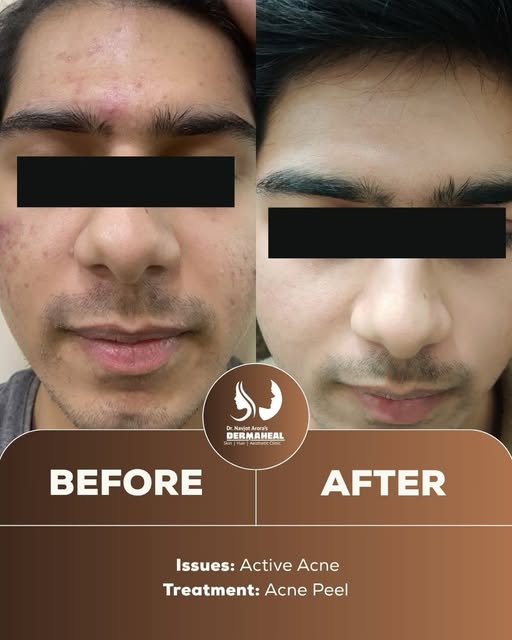 Struggling with acne? You may not need expensive serums or a complicated routine.

The right diagnos