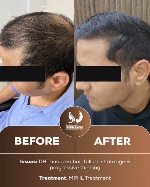 Hair fall isn’t just genetics, it’s DHT quietly shrinking your follicles over time. 🧬 
This transfo