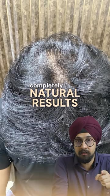 A hair transplant is not an overnight transformation. It’s a process. 

From surgery to the first vi