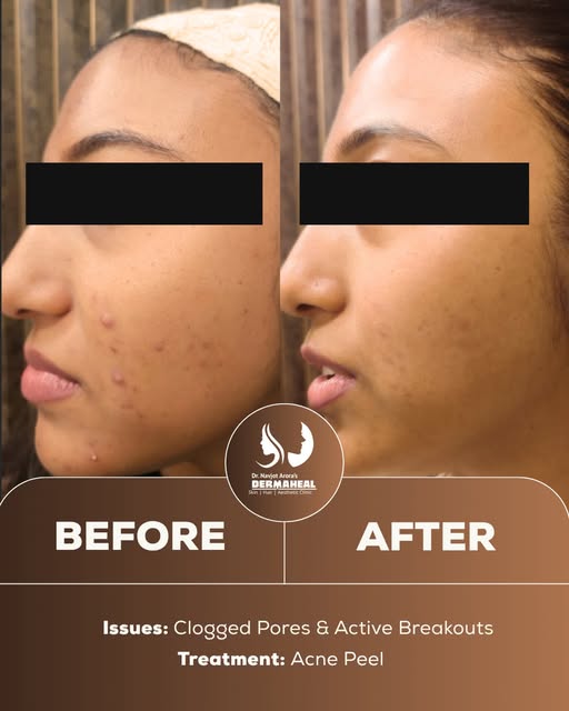 When right approach treats right skin concern. 
This patient came in with clogged pores and active b