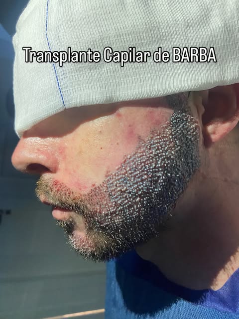 Você tem falhas na barba ou gostaria que sua barba fosse mais cheia e densa?
Saiba que o Transplante