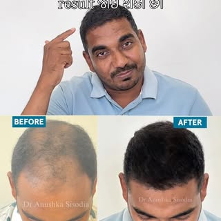 Honest and Amazing patient testimony by our hair transplant patient. In a hair transplant procedure 