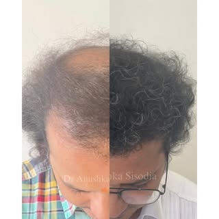 From thinning to thriving 🌟✨ Witness the power of a hair transplant transformation – confidence res