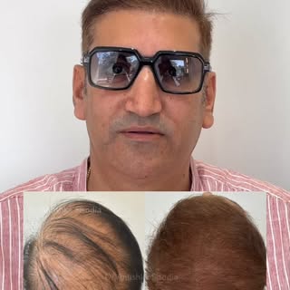 From hiding his hair… to owning his confidence.
This isn’t just a hair transformation — it’s a life 