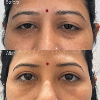 Above shown is a 10 days apart before and after of Blepharoplasty procedure (eyelid surgery) perform