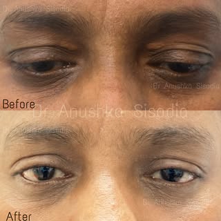 Sometimes the bravest thing you can do is take care of yourself. Say goodbye to Xanthelasma and hell