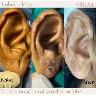 A torn, stretched, or elongated earlobe can happen due to heavy earrings, trauma, or years of wearin