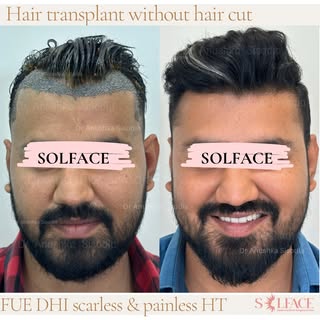 Hair transplant without the head shave—yes, it’s possible.
With the right technique and careful plan