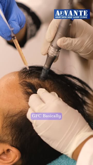 ✨ Advanced GFC Hair Treatment at ADVANTE ✨
Reduce hair fall & boost natural hair growth with safe, d