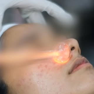 Clear skin starts with the right care ✨
Professional Acne Treatment at advante clinic
✔️ Chemical Pe