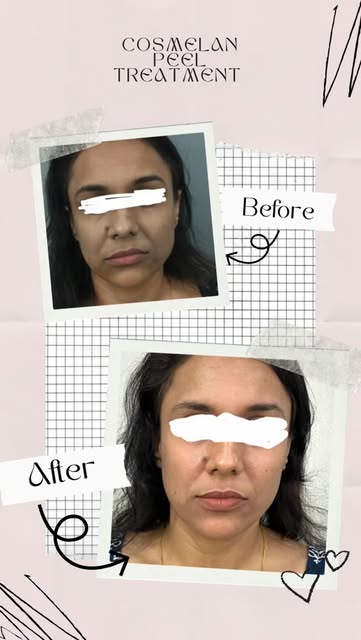 Cosmelan treatment at advante clinic
Book your slot now