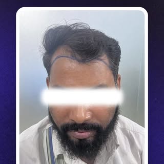 Still searching for proffesional hair transplant clinic ?
Visit advante clinic and book your slot no