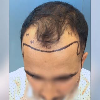 Confidence restored. Hairline renewed. ✨

Another happy hair transplant journey at Advante Clinic. N