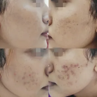 Acnemarks before and after
Strictly on just a basic skin care routine and here it is ,our beautiful 