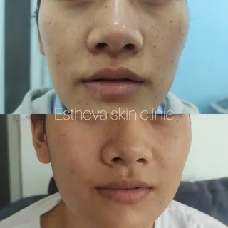 Freckles Before/ After
.
.
. 

Contact us 
9802329868/014442335/014442336
Estheva skin clinic
KTM,Ne