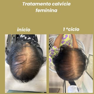 Tratamento para calvície feminina independente da idade gera resultados extraordinários!!! Nesse cas