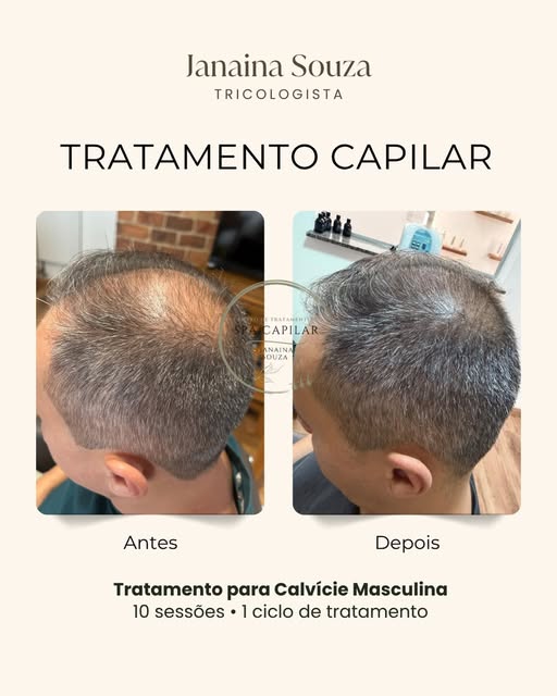 Tratamento calvície masculina! Protocolo exclusivo. Sessões com foco em intensidade e frequência. Ag