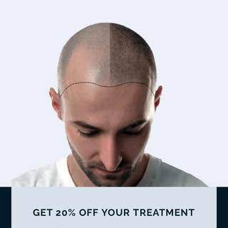 Start the summer with a new look ! 
20%off all scalp micro pigmentation procedures!
Dm or book on ht