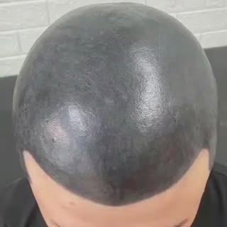 Losing hair really sucks !

Thank god there is a solution to this ! 
It is called scalp micro pigmen