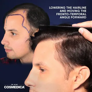 The perfect result of the well planned hairline and careful work.
.⁣
.⁣
.⁣
.⁣
.⁣
#implantecapilar #g