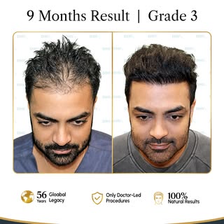 9 Months. One Remarkable Transformation.

From visible hair loss to a fuller, natural-looking hairli