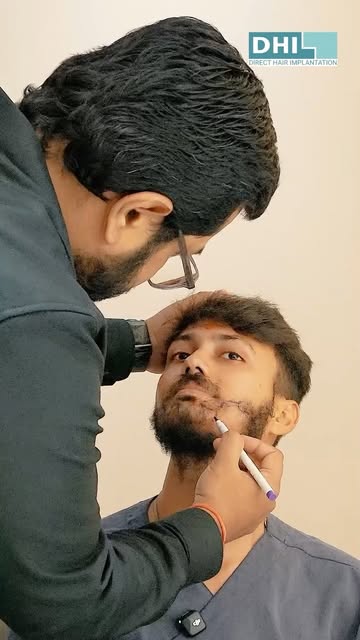 Some transformations are subtle. Until you look twice.
A carefully designed beard transplant, shaped