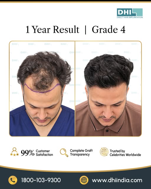 The difference 1 year can make.

From Grade 4 hair loss to a fuller, natural-looking head of hair.

