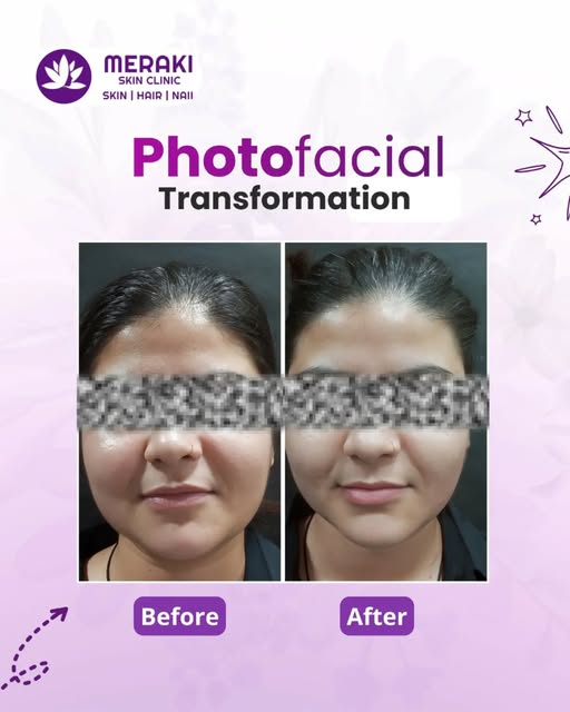 ✨ Photofacial Transformation ✨

Reveal smoother, brighter, and more radiant-looking skin with a prof